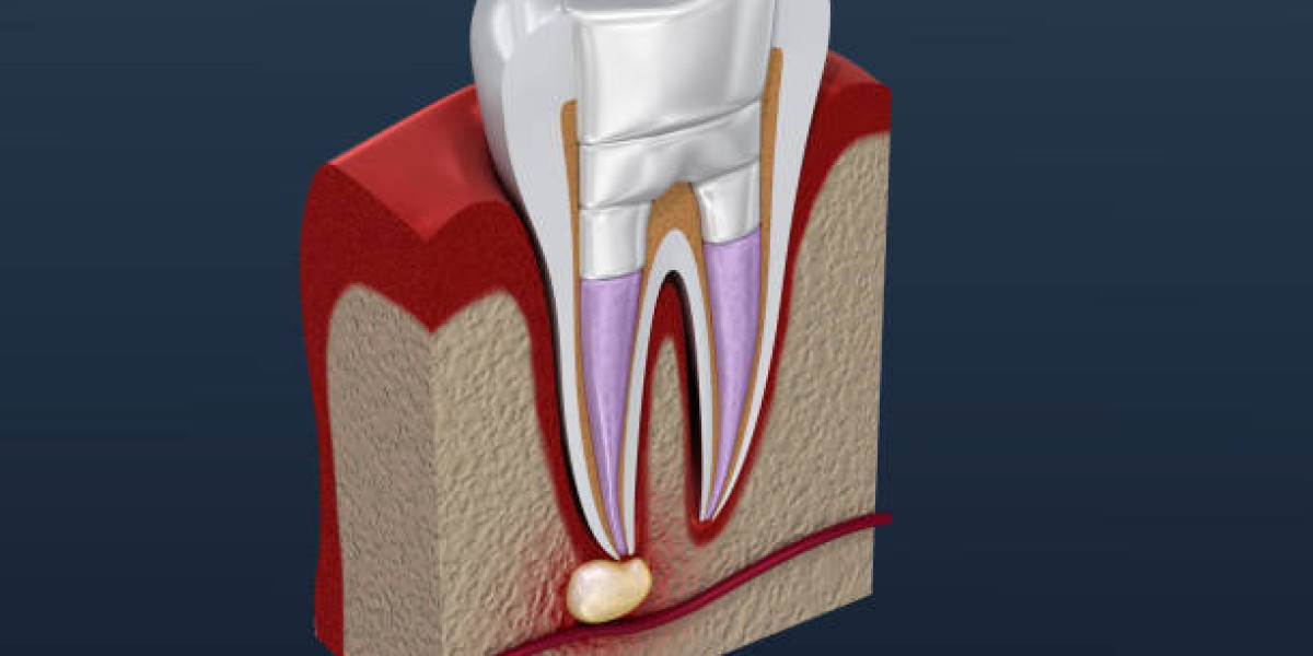 Post-Root Canal Pain Relief: Home Remedies That Actually Work