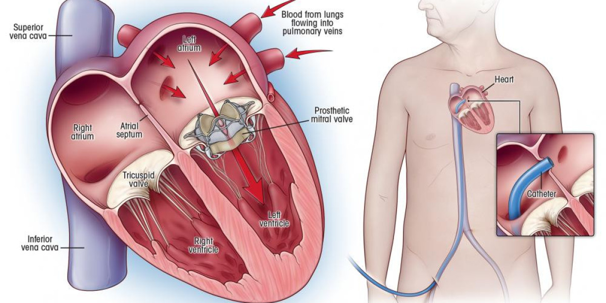 Best Doctors for Heart Valve Replacement Surgery in India