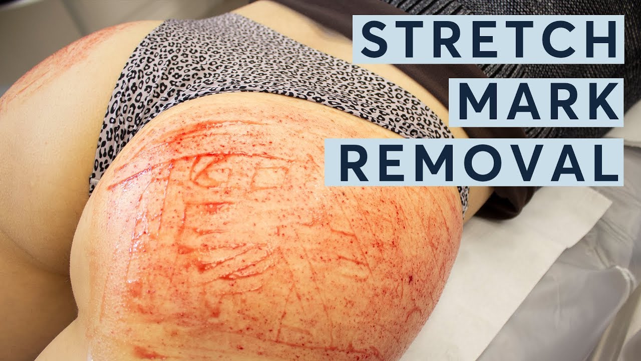 Transform Your Skin with Laser Stretch Mark Removal in London