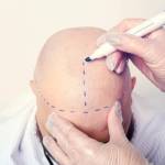 Hair Transplant in Riyadh profile picture
