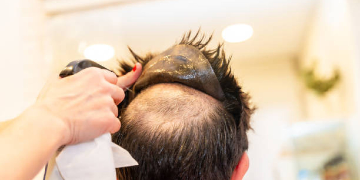 Hair Replacement Procedures for Fuller Healthier Hair