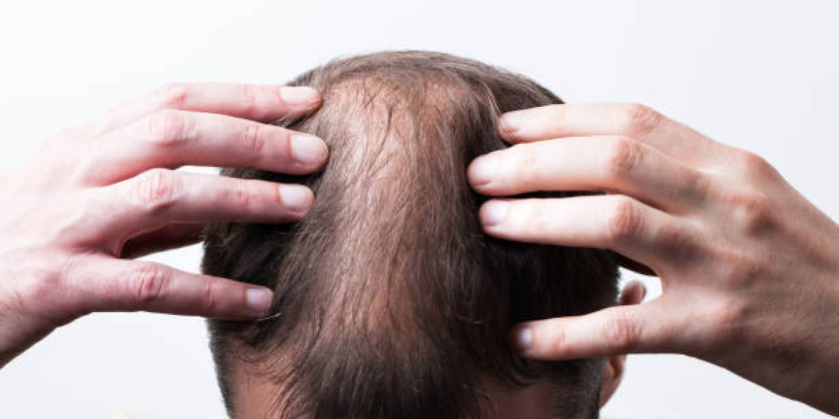 What to Expect from Stem Cell Hair Loss Treatment Results
